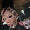 vitiligobarbie_