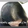 hna_bnt