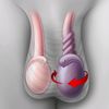 torsiontesticular12