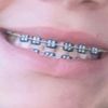 dental_braces_