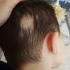 alopecia_areata_