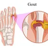 Hỏi đáp về bệnh Gout