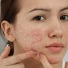 Acne Skin