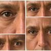 blefaroplastiaa