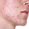 Doctor Pimple