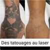 destatouagaulaser
