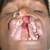 cleft.palate7