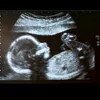 Usg baby