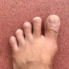 Dr minh toenail