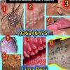 virus.del.vph