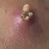 Pimple Satisfying 81