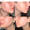 acni.to.glow.skin
