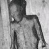 deficientchromosome
