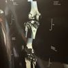 rta.tibial.platue