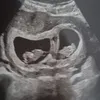 ivfjourneytwins