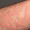 .urticaria