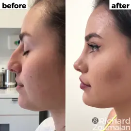 At 9 months #rhinoplasty #beauty #beforeandafter #plasticsurgry