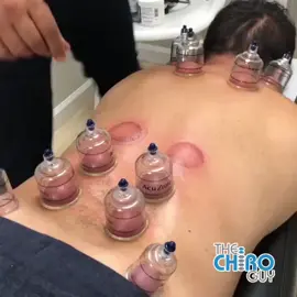 🔥 MYOFASCIAL DECOMPRESSION 🔥 #chiropractor #chiropractic #gay #gaylove #husbands #cupping #muscle #therapy #tiktokgay