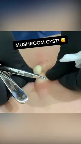 This cyst was quite mushroom-like! 😉#pimple #pimplepopping #pimplepopper #drmudgil