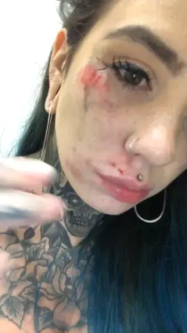 2018 in the ER after falling on traintracks vs a few days after. 😅 #firsttiktok