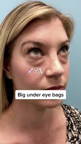 Beautiful new eyes. Bags be gone.  #transformation #fyp #undereyebags #darkcircles #blepharoplasty #eyechallenge #tiredeyes