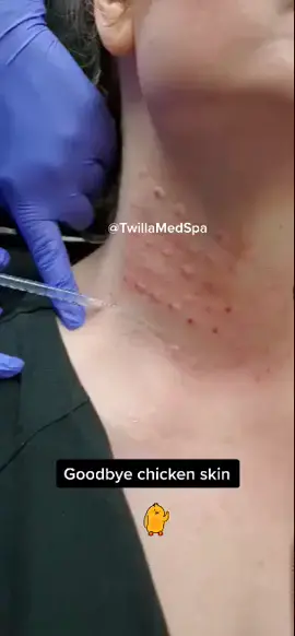 Microtox AKA Baby Botox 💉#fyp #foruyou #BestThingSince #botox #twillamedspa #skincare #trending