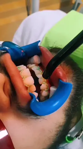 Blanqueamiento dental Disfrútalo !#tiktokchallenge #blanqueamientodental #sonrisachallenge #sonrisaradiante