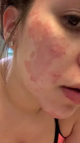 Day 3. Freddie Krueger lookin ass. I applied only fresh aloe Vera from my backyard #wax #beauty #fyp #carolbaskin #thatbitch #healing #faceburn