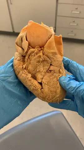 ATRIAL FIBRILLATION!! #emtlife #heart #education #learning #cool #EduTok #homeschool #nurselife #amazingfacts #healthy