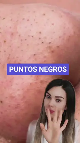 Puntos negros, ¿por qué? #eliminalos #medicina #dermatologia #dermatologa #skintips #pielbella #beautytips #skincareroutine #skincare