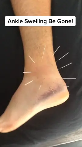 Great technique to reduce ankle swelling 🤕 #acupuncture #swelling  #aussiethings #health #medical #physio #therapy #ankle #pain #wow #chinese #crazy