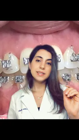 Top 3 tools to keep braces clean! #dentist #littlethings #LearnOnTikTok #braces