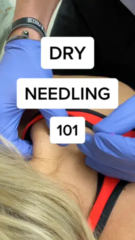 Dry Needling #LearnOnTikTok #alwayslearning #physicaltherapy #posture #neckpain