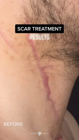 IMPROVING SCARS WITH #LASER | #scar #beforeandafter #dermatologist #fyp #scarremoval