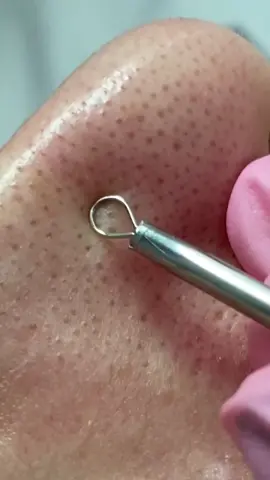 #pimple #pimplepopping #pimplepoppingvideos #skincare #sebacousfilaments #fyp #foryou