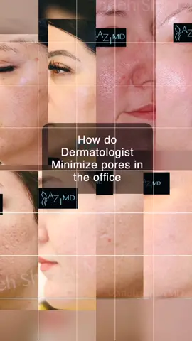 Do Dermatologist minimize pores in the office? #skincaretips #skincareregimen #tiktokdoc #beforeandafter #beforeafter #glassskin #kskincare