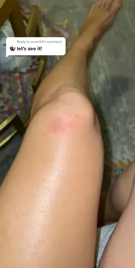 Reply to @scosh24 It’s been over a week and I still have a swollen knee and nerve damage ... hopefully gonna get better soon 💙