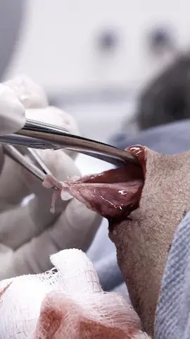 It...pooted? Ok. @drpimplepopper #DrPimplePopper #saywhat #gross #pimplepopping