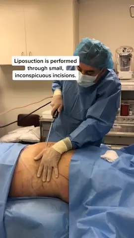 Liposuction procedure. #fyp #foryou #foryoupage #liposuction #fatremoval #doctor #doctorlife #plasticsurgeon #plasticsurgery #plasticsurgerycheck