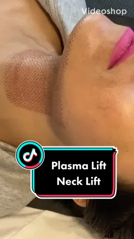 #plasmalift #Necklift #nonsurgical #fibroblast #plasmalifting #plasmafibroblast #naturalalternative #noninvasive