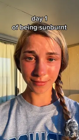 before you guys come at me I actually did use sunscreen😫 #sunburn #Summer #summervlog