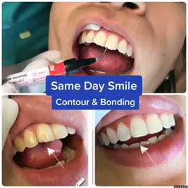 Enhance your smile. #smilemakeover #dentist #foryoupage #viral #CanYouWorkIt #smilequeen #invisalign
