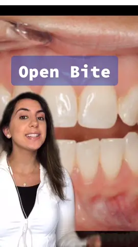 All about open bite! #tiktokpartner #LearnOnTikTok #dentist #braces #teeth treatment pics: IG Dr Trevor Nichols