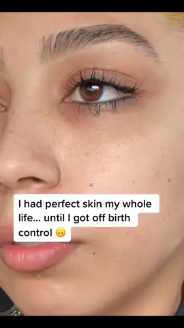 Thought I'd share to see if anyone else is dealing with hormonal acne 🙏🏼 #acneskin #skincaretips #hormonalacne #acneskincare