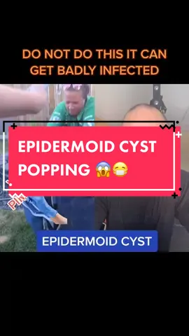 #duet with @skarring Epidermoid Cyst #LearnOnTikTok #brownsanatomy #plasticsurgery
