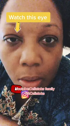 Silly eye! Result of an operation on my left 👁🤣 #eye #partytricks #squint. Subscribe to my YT and Follow my IG 🥰