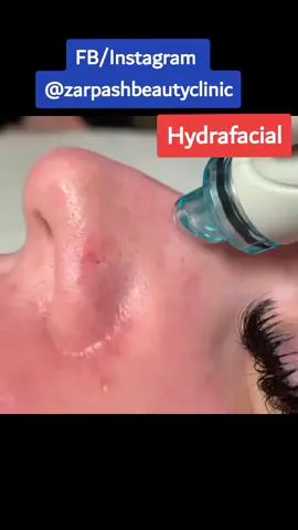 watch your blackheads vanish with #hydrafacial painless procedure #zarpashbeautyclinic #foryoupage #foryou #petlover #sportslover #viral #trending#fyp