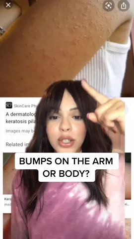 so many of you asked about this!!! #acneskin #acnetreatment #bodyacne #LearnOnTikTok #tiktokpartner