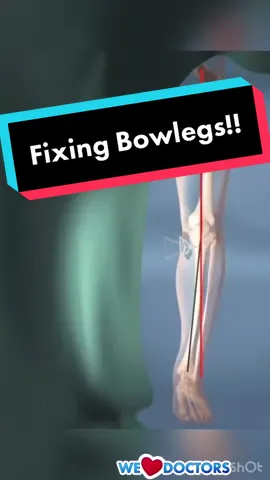 Another #medicalanimation this time showing the correction of Bowlegs! 👊 #knockknee #knockknees #bowlegs #bowleg #bowleggedstruggle #fixbowlegs #fit