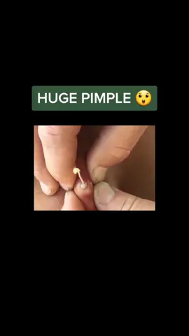 Gloves is a must with this one 😲 #fypシ #satisfying #pimplepopping #oddlysatisfying #fyp